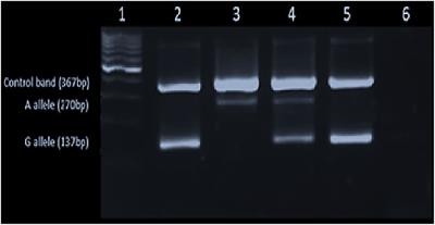 Frequency of Hereditary Hemochromatosis Gene (HFE) Variants in Sri Lankan Transfusion-Dependent Beta-Thalassemia Patients and Their Association With the Serum Ferritin Level